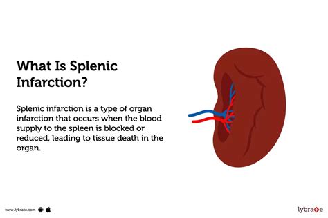 It is important to understand the anatomy and physiology of the spleen prior to performing a <b>splenectomy</b>. . Splenic infarct treatment uptodate